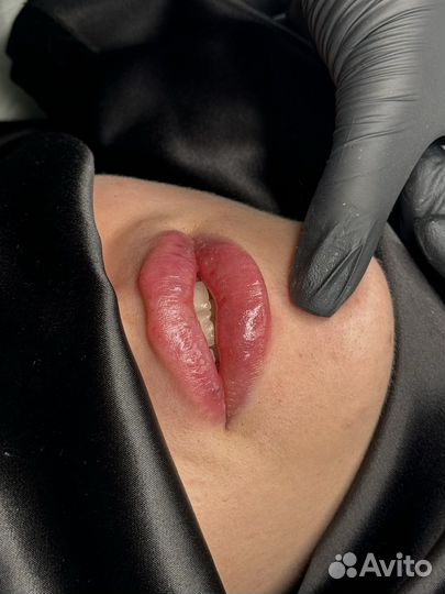 Увеличение губ