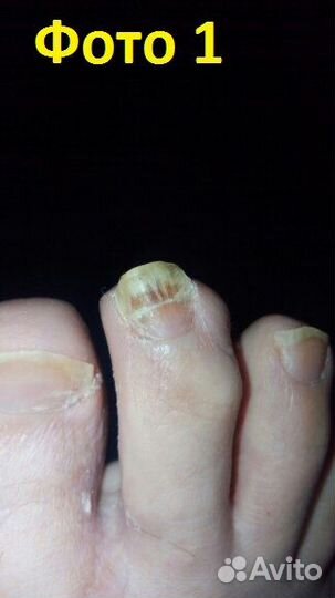 Лечение онихомикоза (грибка ногтей)