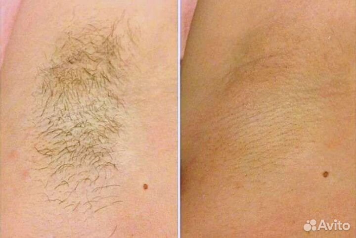 Депиляция воском