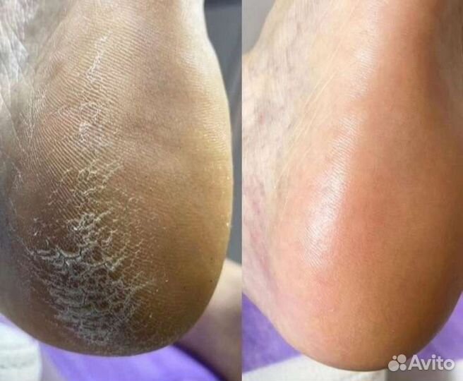 Педикюр мужской, женский,подолог,нить