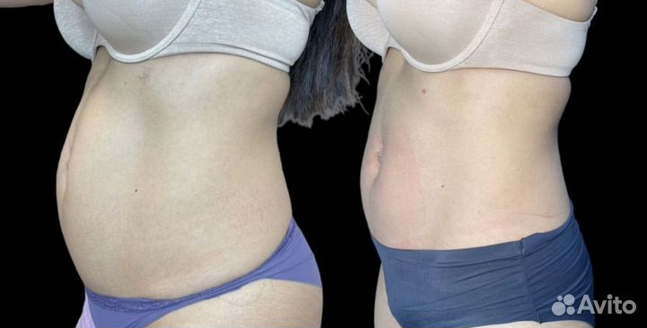 Электромагнитная стимуляция пресса (emsculpt)