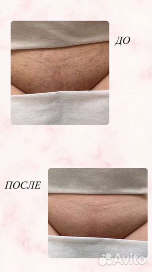 Депиляция Шугаринг Фитосмола Ильиногорск