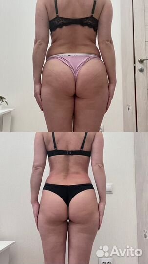 Антицилюлитный массаж, лазерная эпиляция, парнас