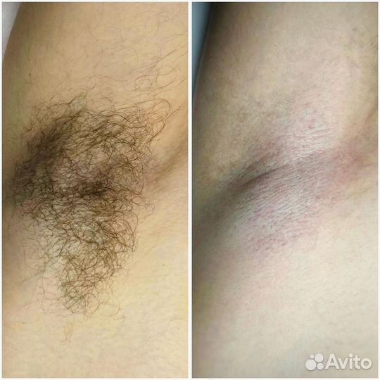 Шугаринг/восковая депиляция