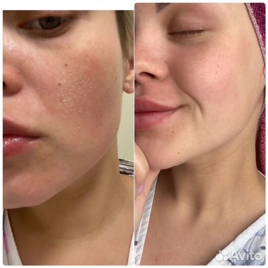 Восстанавливающий крем (псориаз,дерматит и тд)