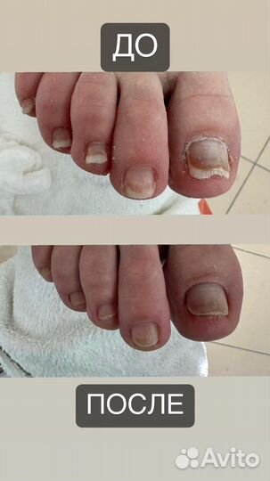 Подолог педикюр