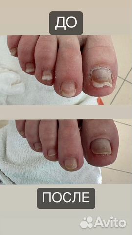 Подолог педикюр