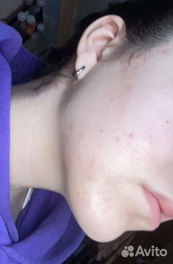 Крем от акне