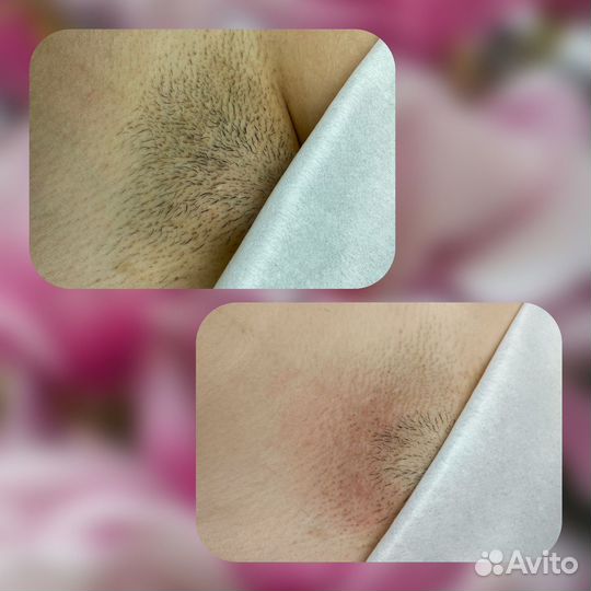 Электроэпиляция