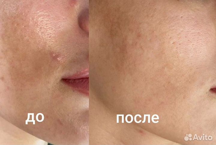 Пилинг лица- Цитолайф, Мезоматрикс