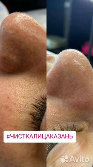 Косметолог Чистка лица Пилинг Биорепил