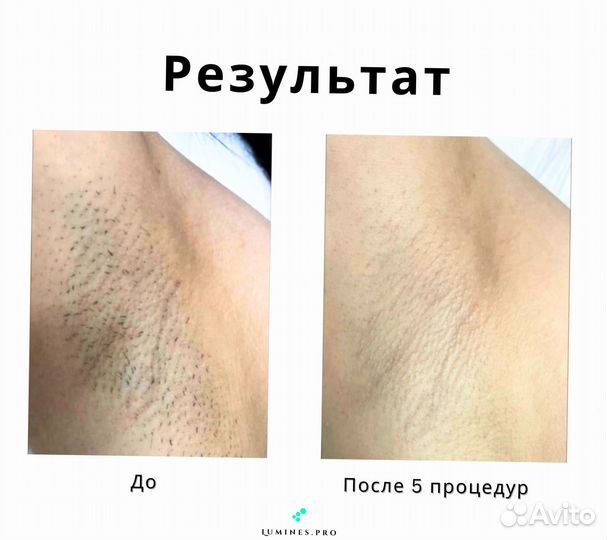 Диодный лазер для эпиляции Lumines MaxOne 1200W