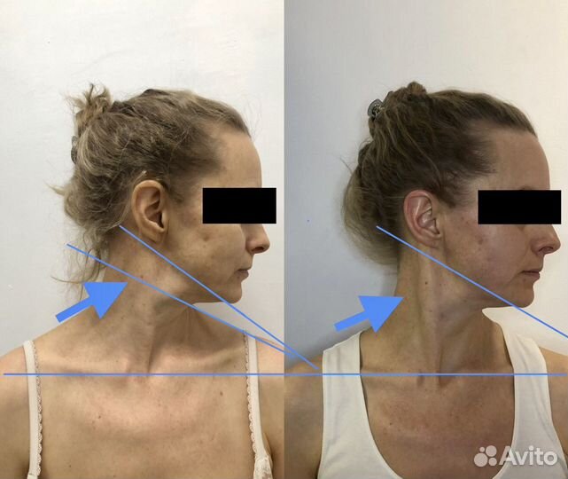 Массаж лица и головы миофасциальный