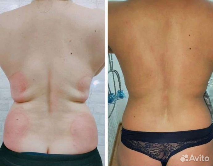 LPG - аппаратный массаж Антицеллюлитный массаж