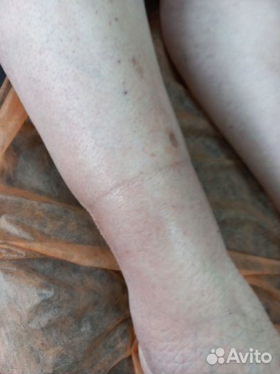 Карбокситерапия