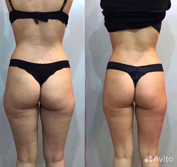 Криолиполиз самая эффективная методика похудения