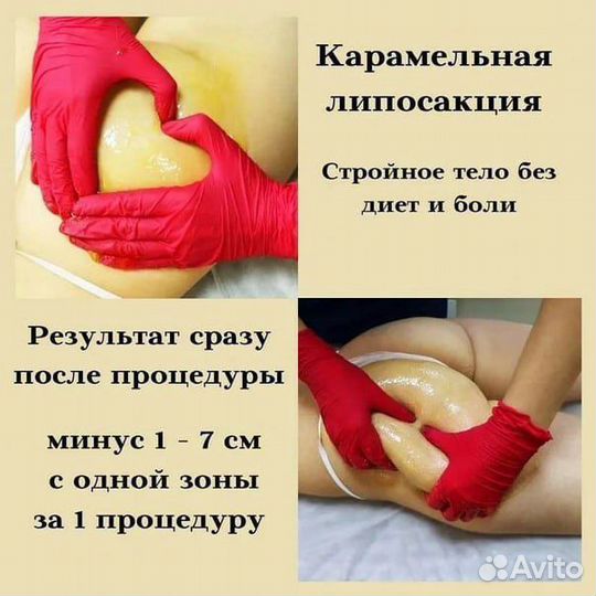 Карамельная липосакция