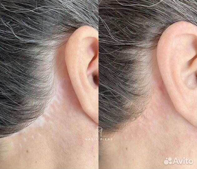 Камуфляж шрамов, рубцов, растяжек, витилиго