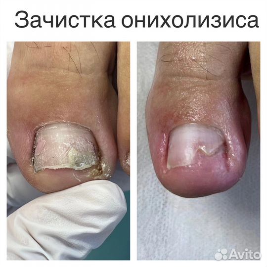 Педикюр подолог