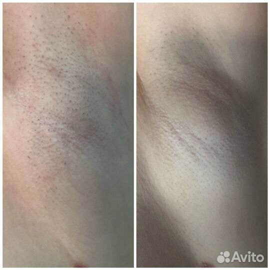 Эпиляция elos