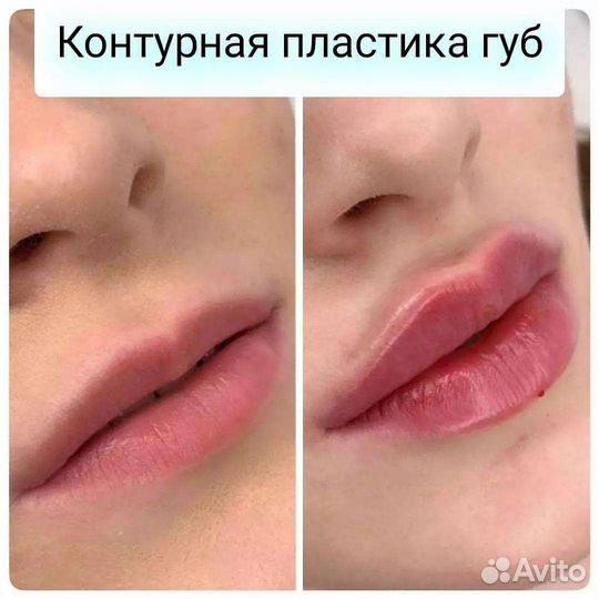 Увеличение губ