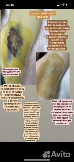 Лечение гипергидроза