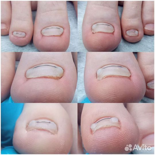 Титановая нить, Коррекционный педикюр