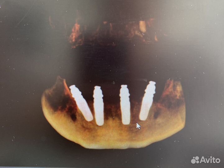 Все на 4х/all on 4