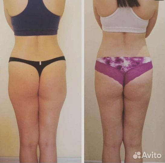 Ручная липосакция