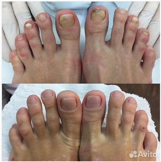 Бесплатный педикюр - решаем сложные случаи