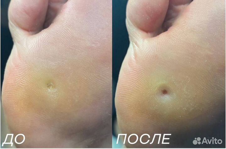 Врач подолог, медицинский педикюр