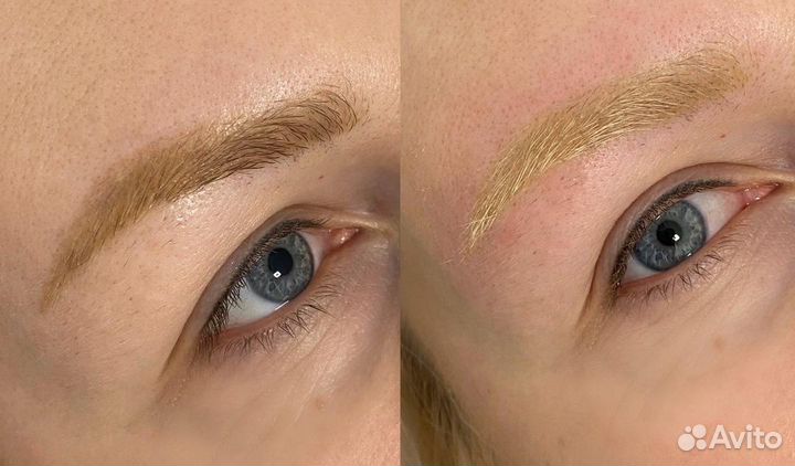 Удаление перманентного макияжа / татуажа