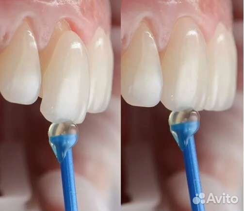 Купон Скидка Виниры, люминиры