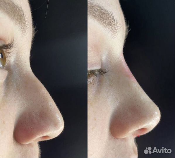 Увеличение губ, коррекция носа