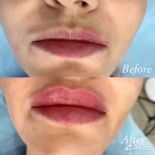 Мануальная мезотерапия