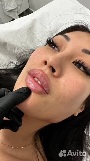 Увеличение губ