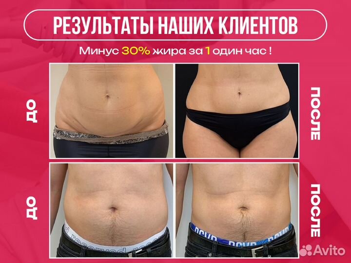 Криолиполиз для мужчин, похудение, убрать жить