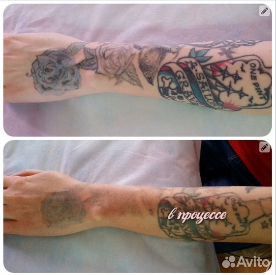 Лазерное удаление татуировок
