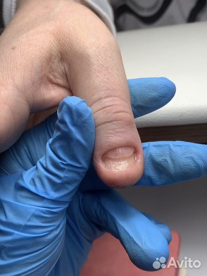 Подолог, медицинский педикюр, титановая нить