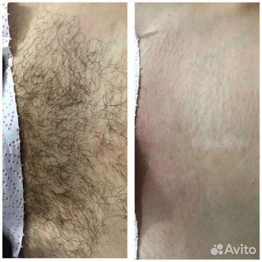 Депиляция мужская и женская