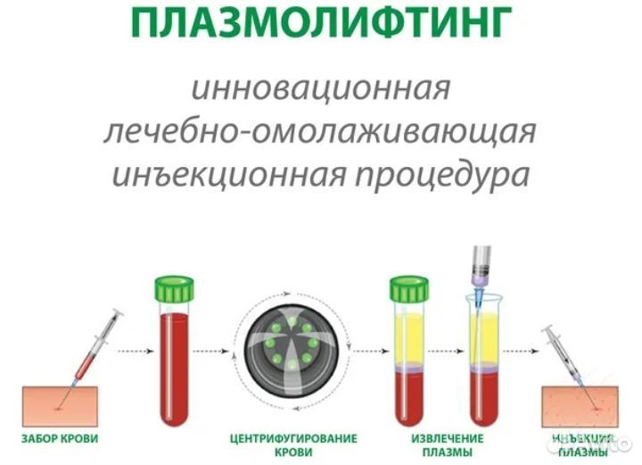 Плазмолифтинг