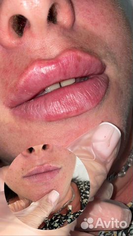 Увелечение губ;Ботулинотерапия объявление продам