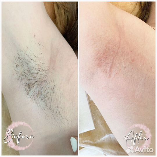 Шугаринг метро Беговая