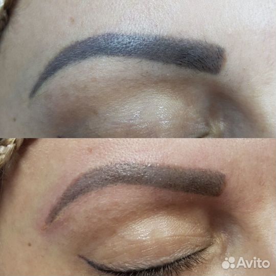 Удаление татуажа и тату лазером