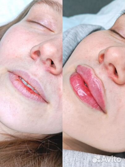 Увеличение губ Скидка 50%