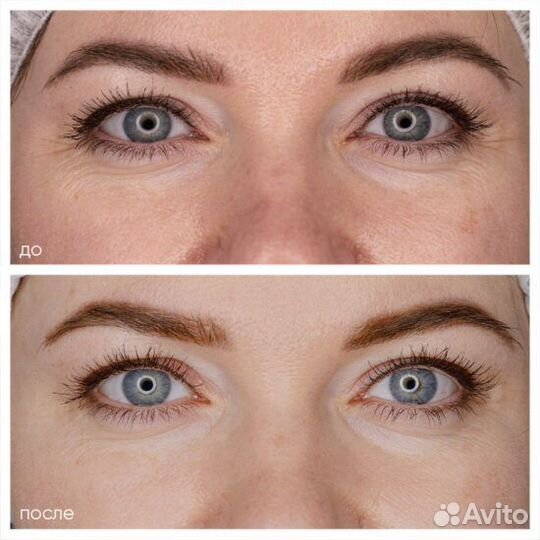 Устранение мешков под глазами