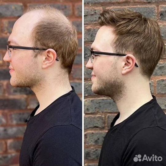 Система волос для мужчин