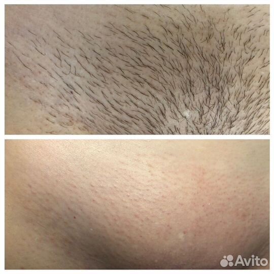 Восковая депиляция и шугаринг