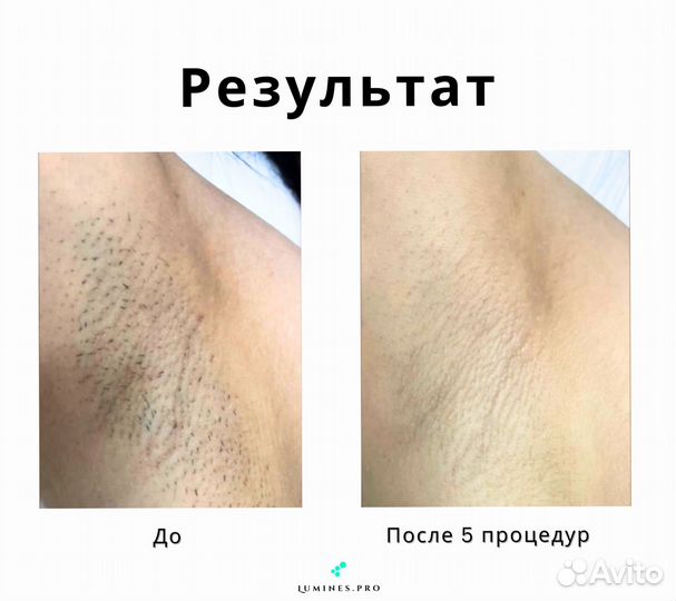 Диодный лазер для эпиляции Лю'Минес Макс-Ван 1200в