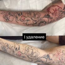 Удаление тату, татуажа, татуировок лазером, Москва